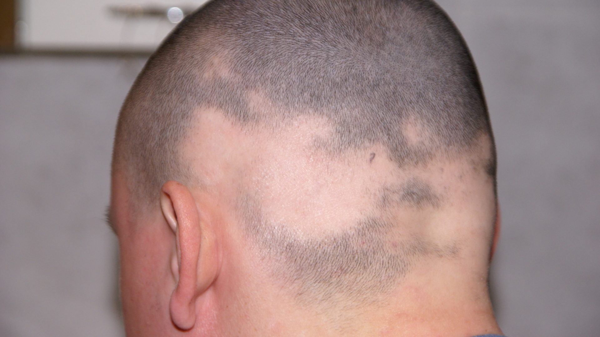 Alopecie (vypadávání vlasů)